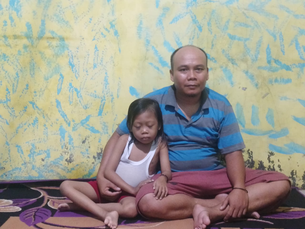 Anak Penderita Thalasemia Plus Gizi Buruk di Medan Labuhan Butuh Bantuan